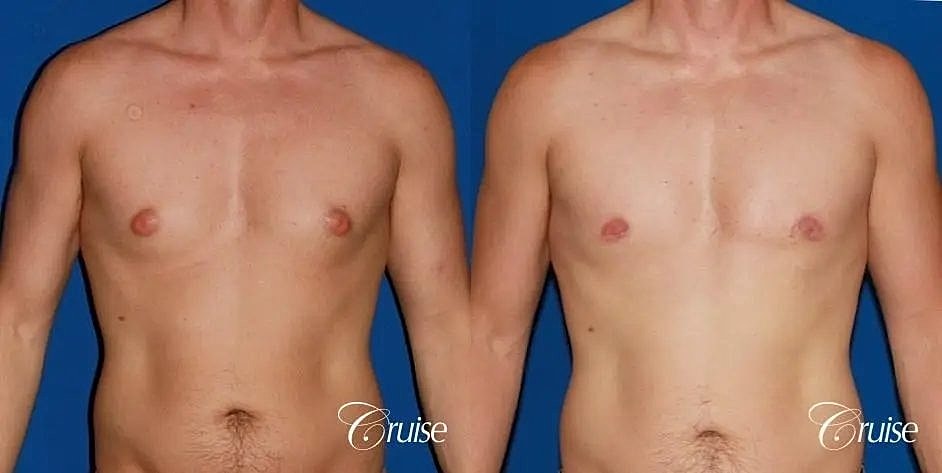 Gynecomastia Before & After
