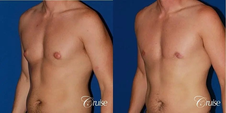 Gynecomastia Before & After
