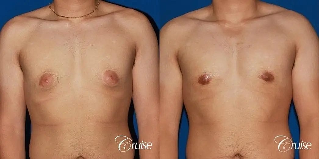 Gynecomastia Before & After