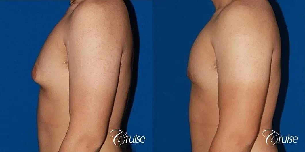 Gynecomastia Before & After
