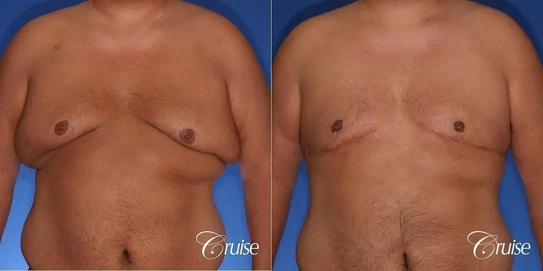 Gynecomastia Before & After