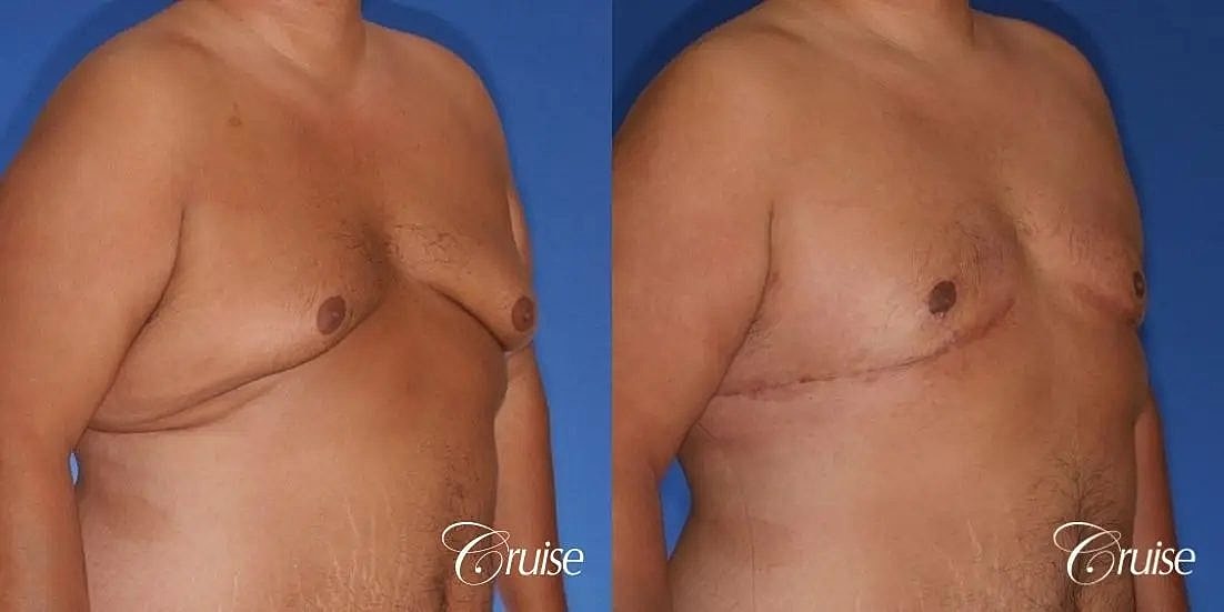 Gynecomastia Before & After
