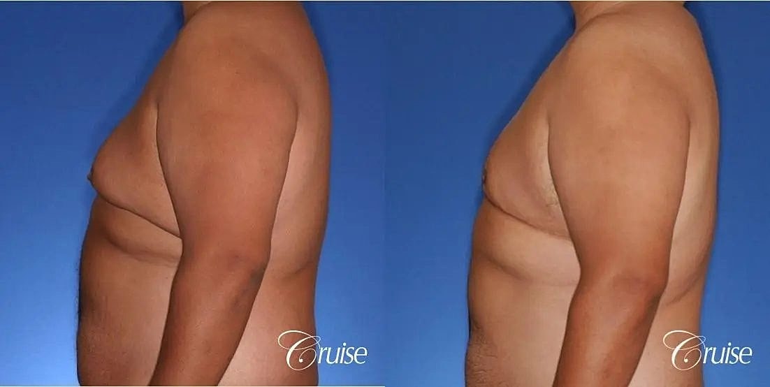 Gynecomastia Before & After