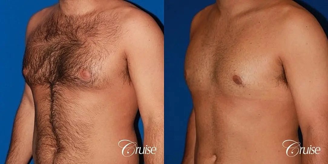 Gynecomastia Before & After