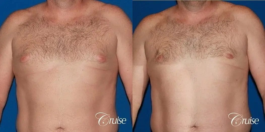 Gynecomastia Before & After
