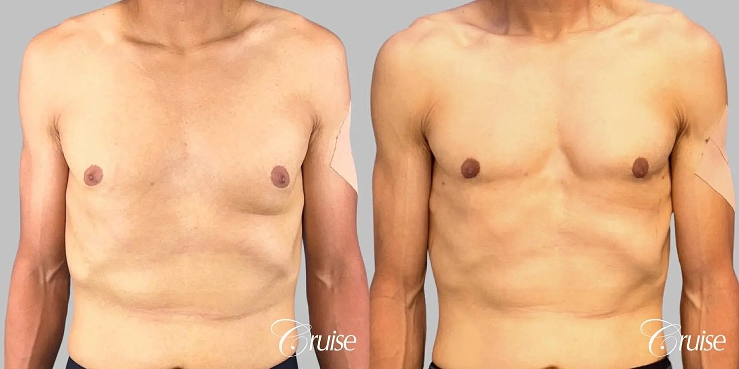 Gynecomastia Before & After