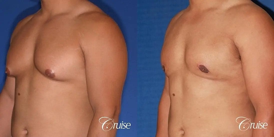 Gynecomastia Before & After