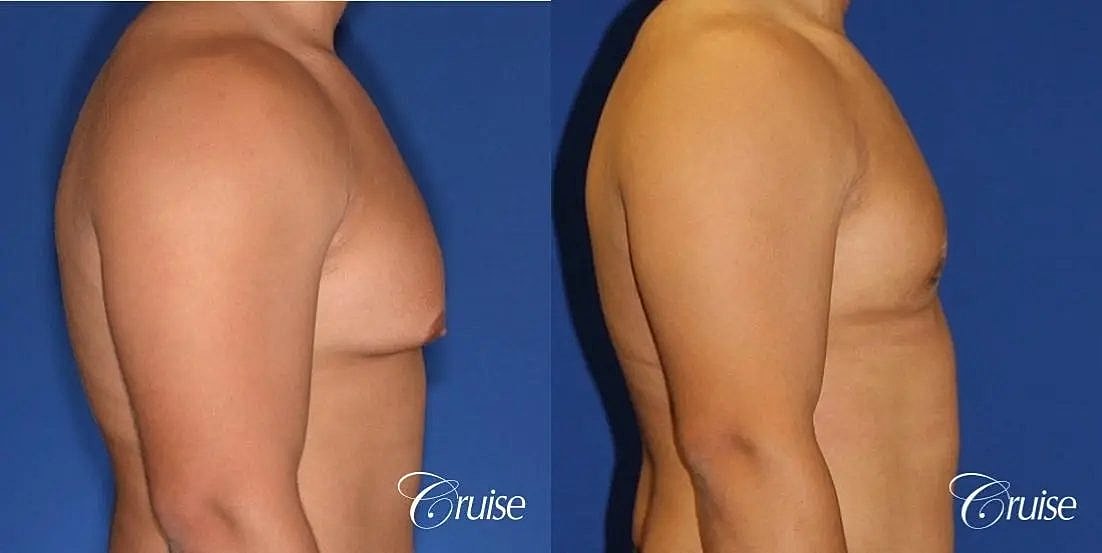 Gynecomastia Before & After
