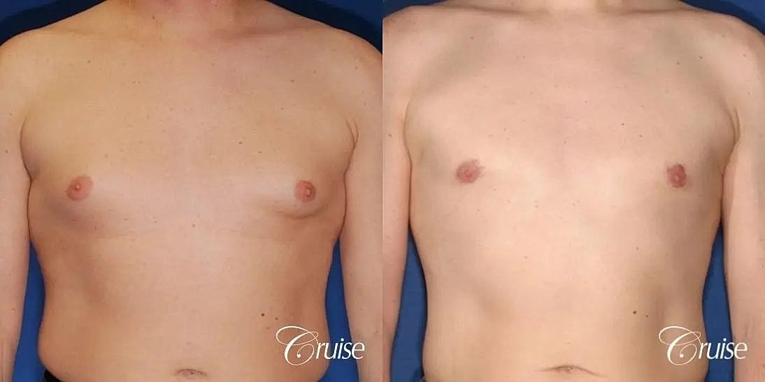 Gynecomastia Before & After
