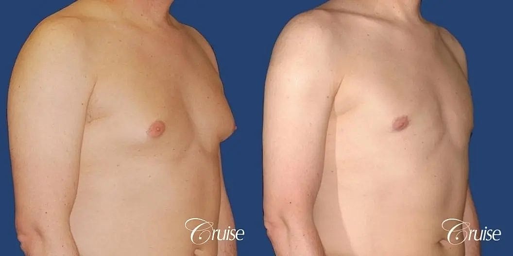 Gynecomastia Before & After