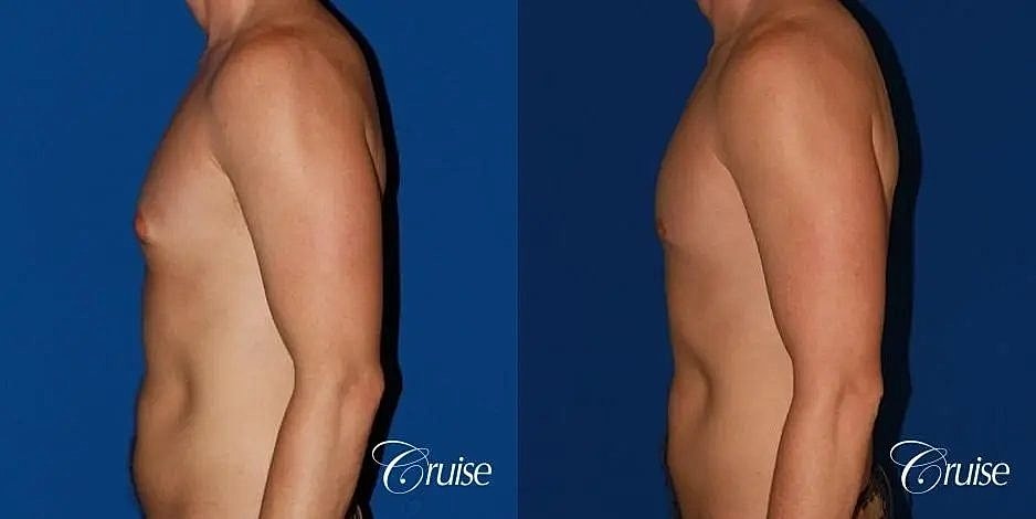 Gynecomastia Before & After