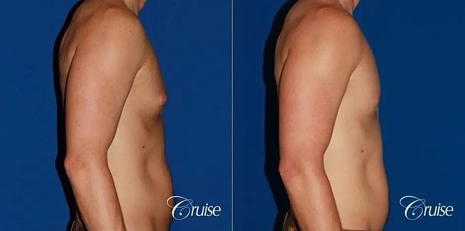 Gynecomastia Before & After