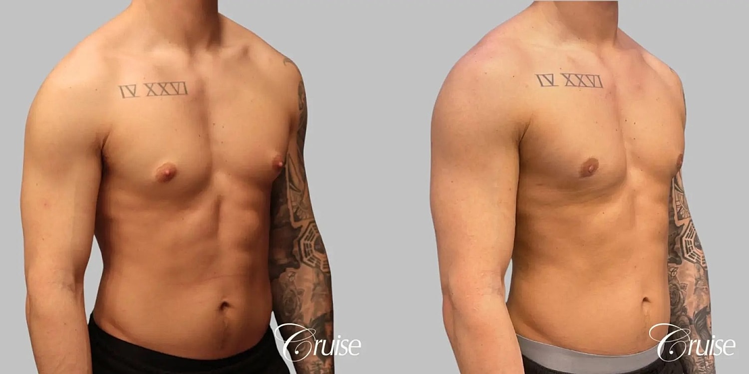 Gynecomastia Before & After