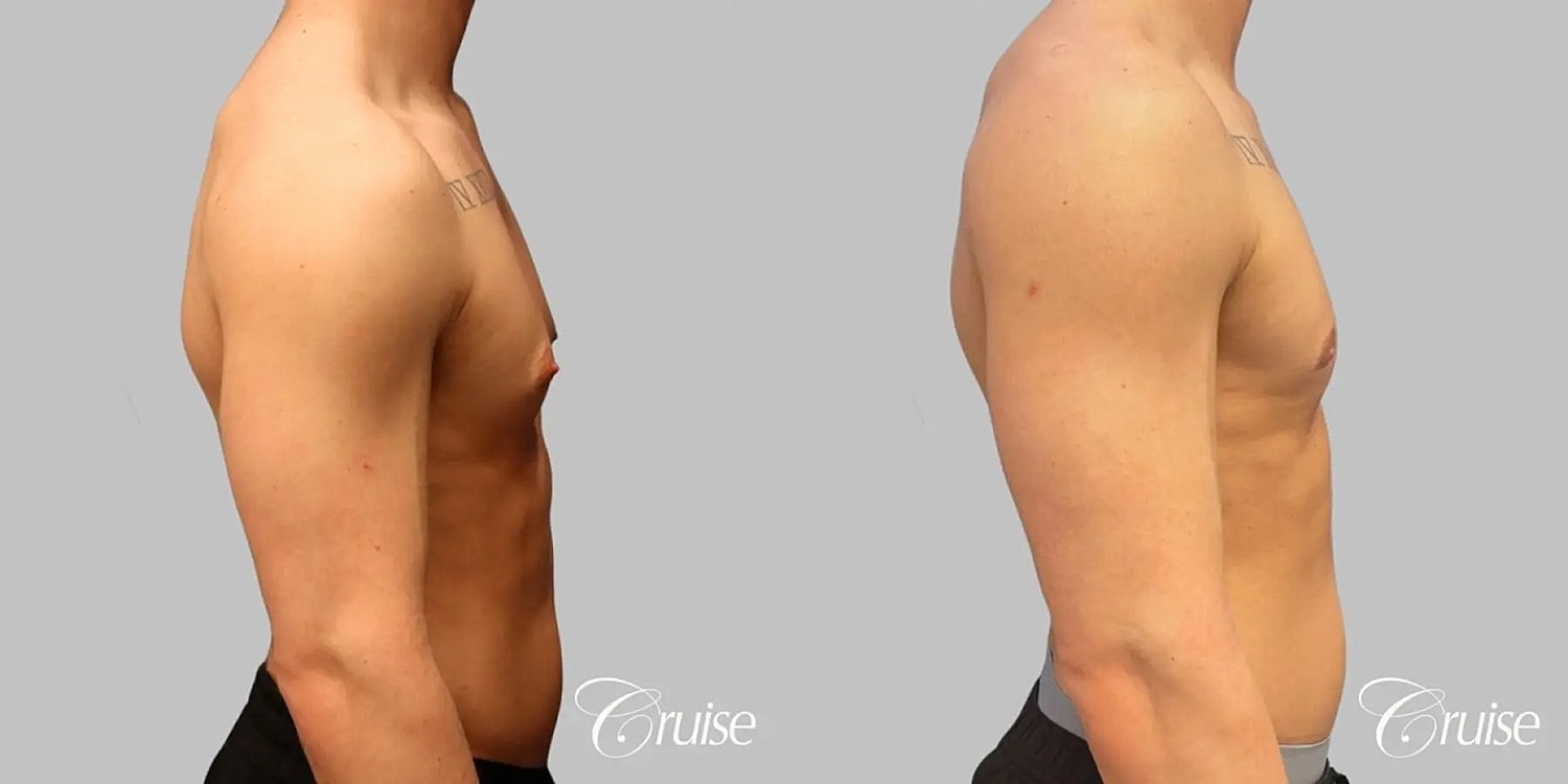 Gynecomastia Before & After