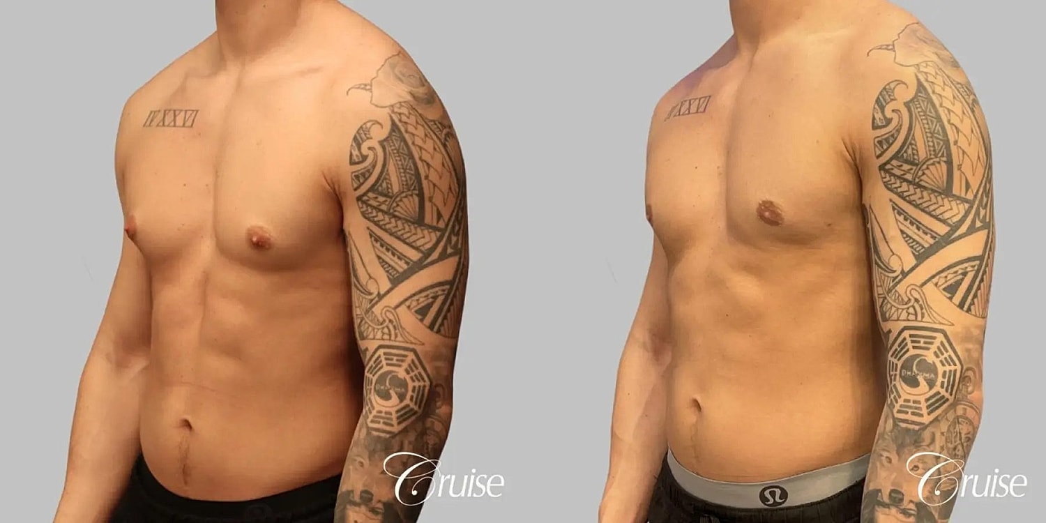 Gynecomastia Before & After