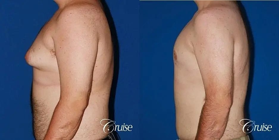 Gynecomastia Before & After