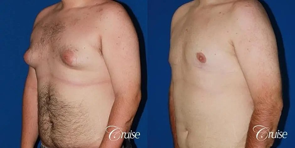 Gynecomastia Before & After