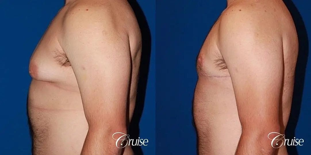 Gynecomastia Before & After