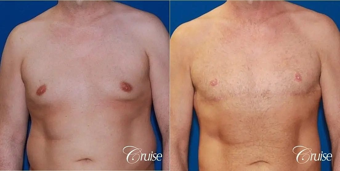 Gynecomastia Before & After