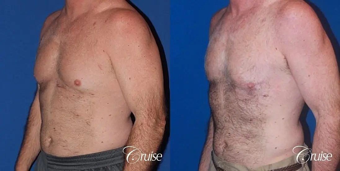 Gynecomastia Before & After