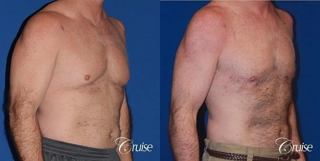 Gynecomastia Before & After