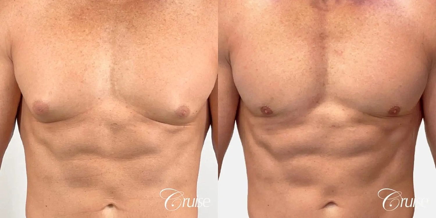 Gynecomastia Before & After