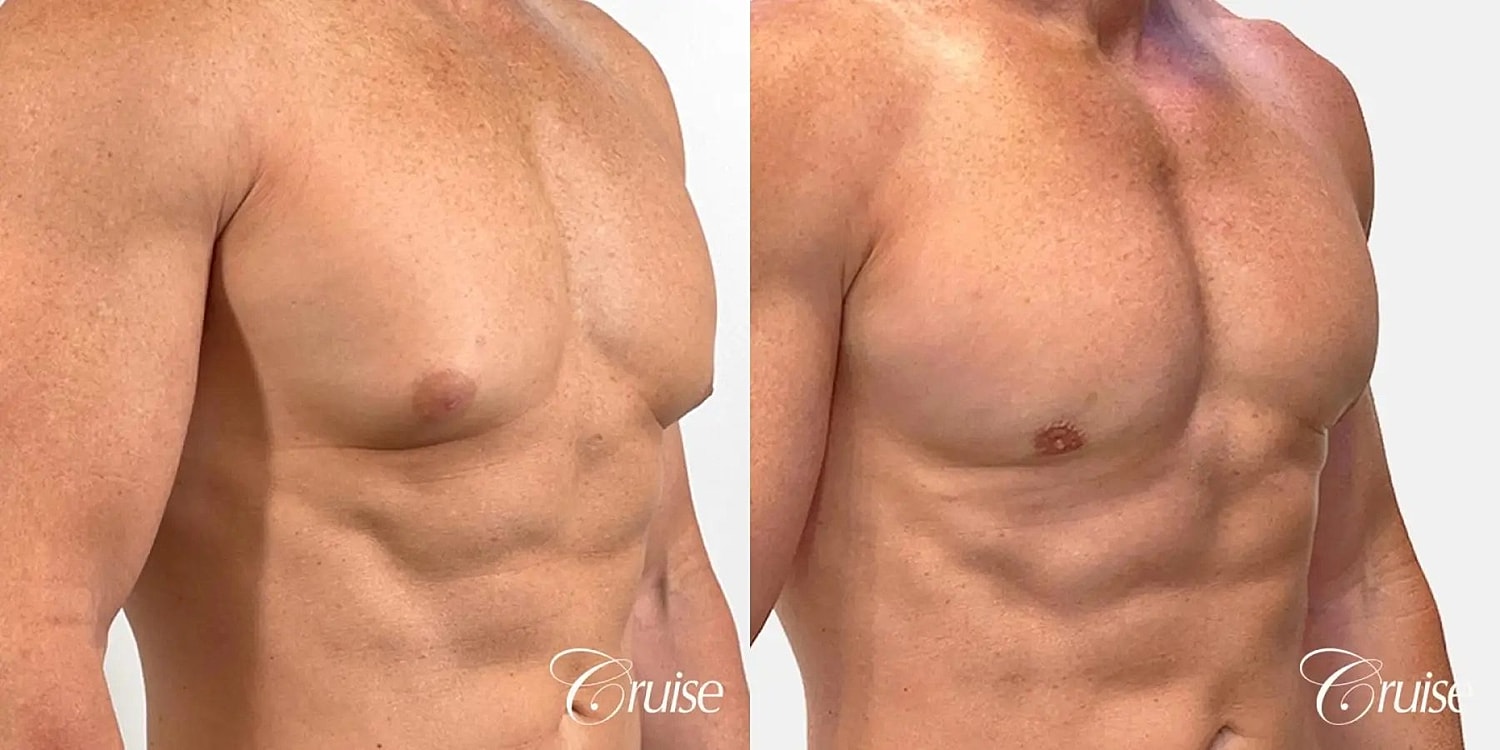 Gynecomastia Before & After