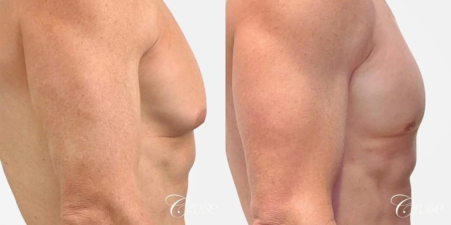 Gynecomastia Before & After