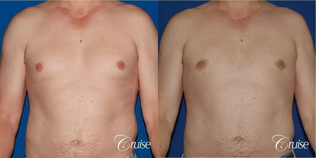 Gynecomastia Before & After