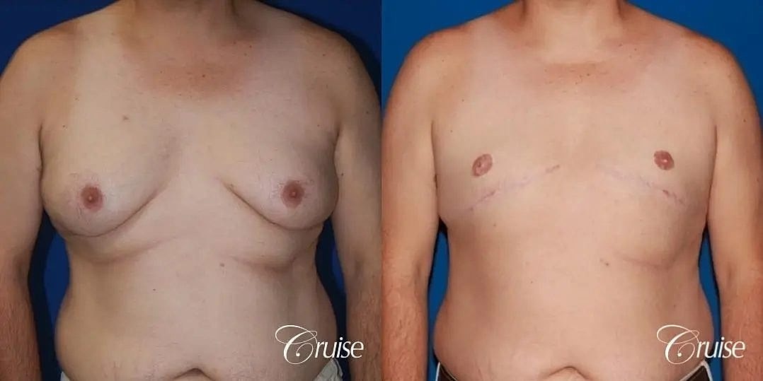 Gynecomastia Before & After