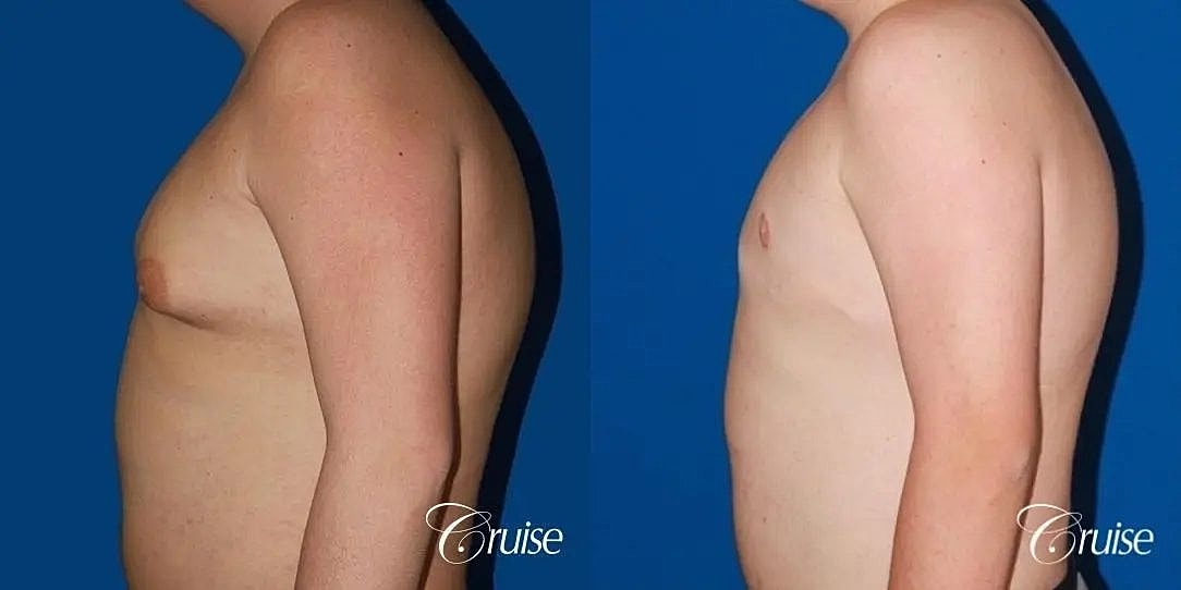 Gynecomastia Before & After
