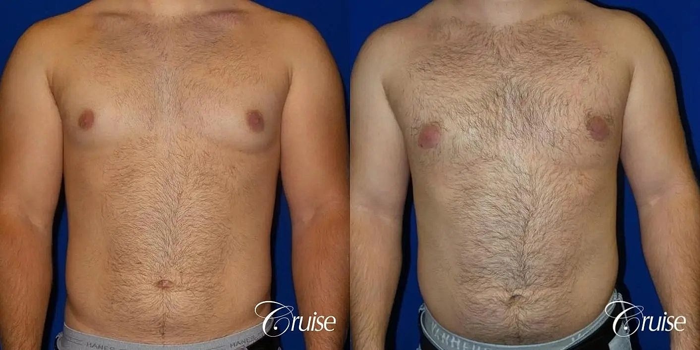 Gynecomastia Before & After