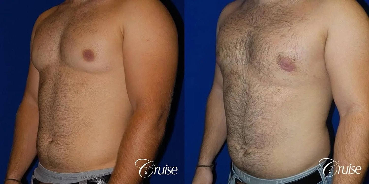 Gynecomastia Before & After