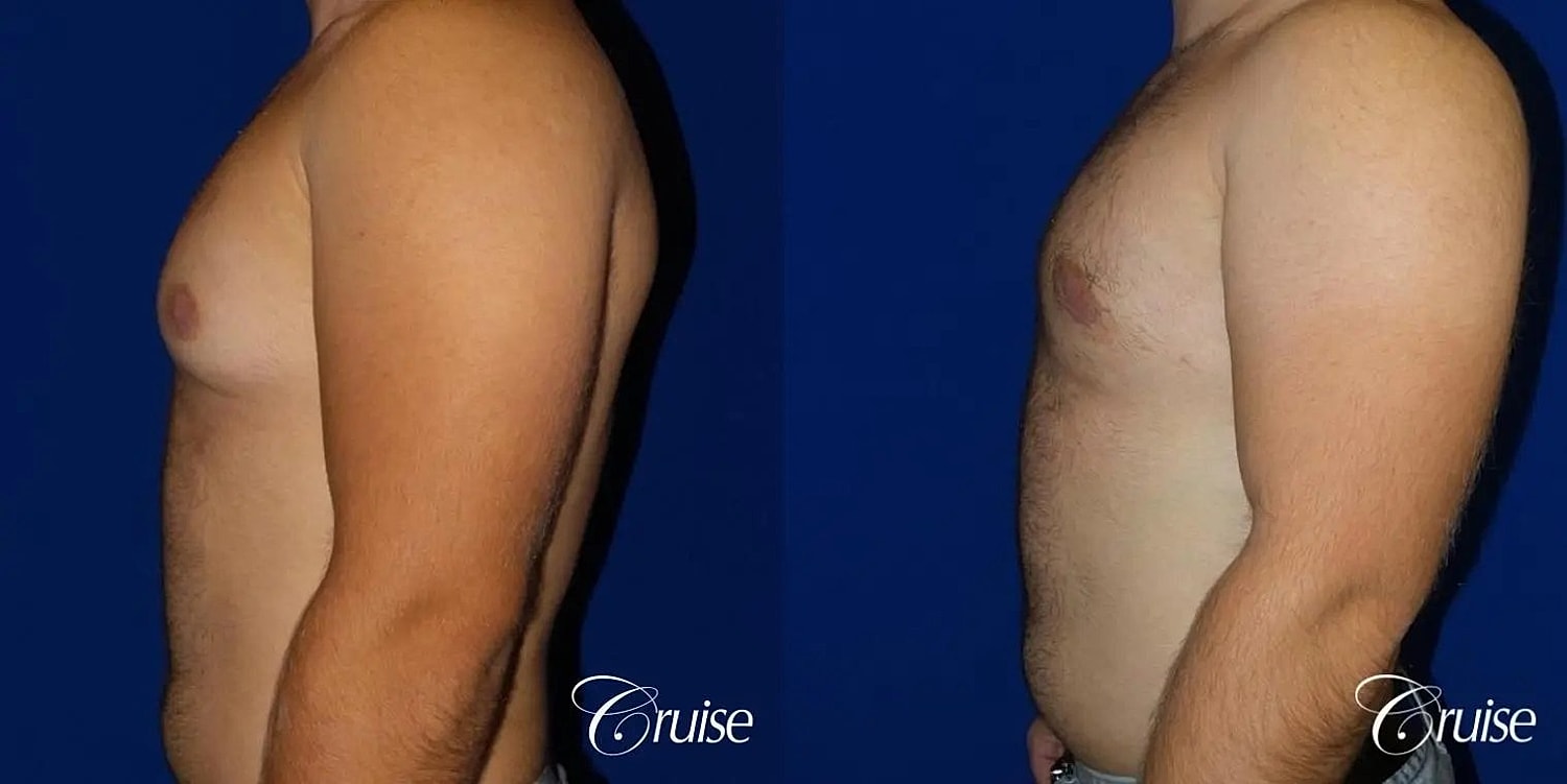 Gynecomastia Before & After