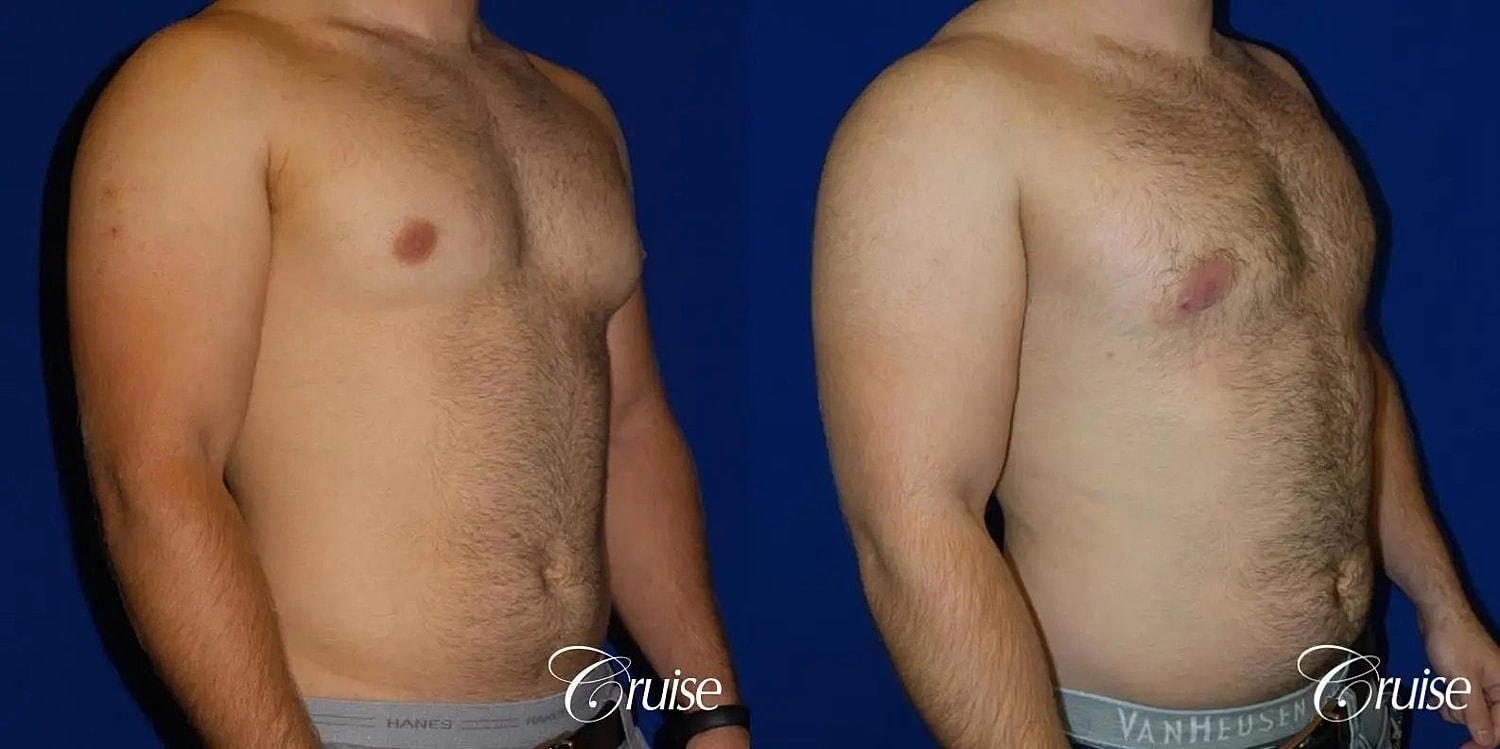 Gynecomastia Before & After