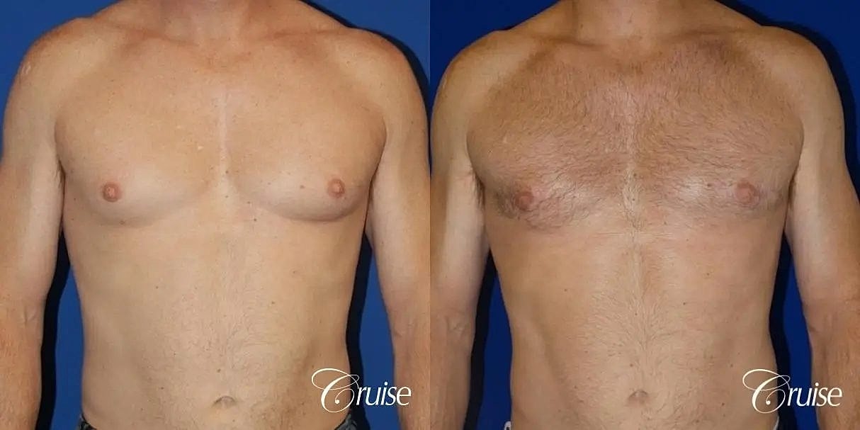 Gynecomastia Before & After