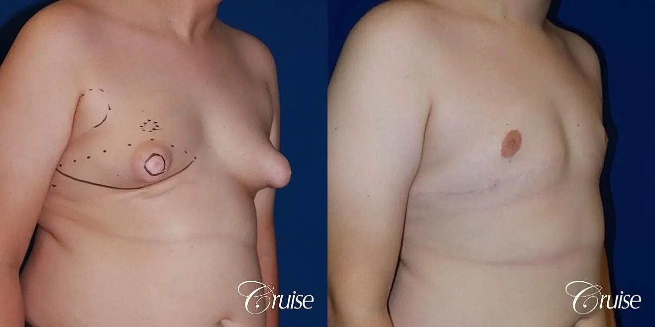 Gynecomastia Before & After