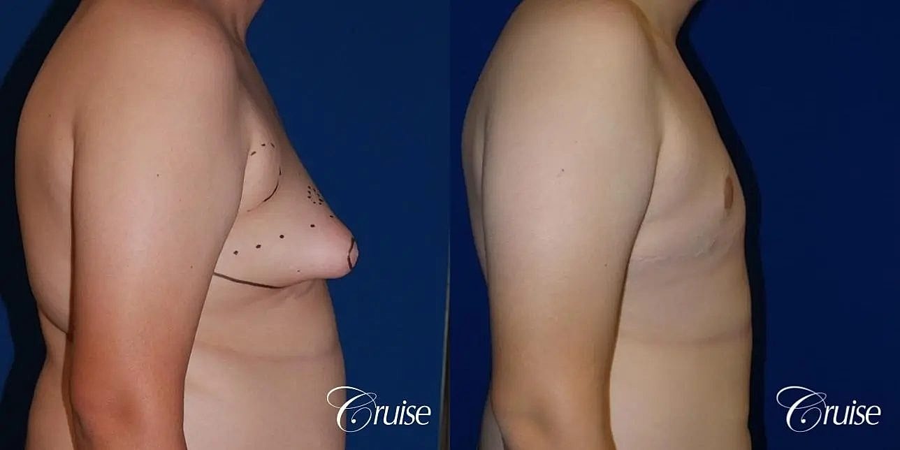 Gynecomastia Before & After