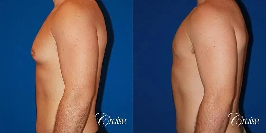 Gynecomastia Before & After