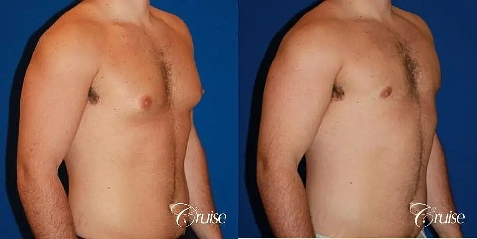 Gynecomastia Before & After