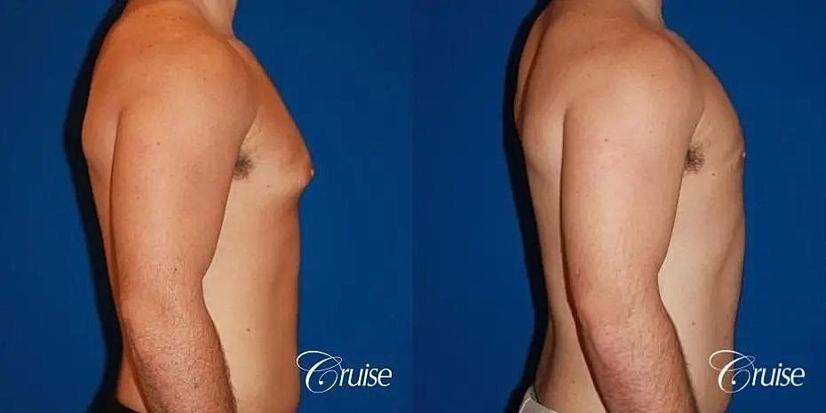 Gynecomastia Before & After
