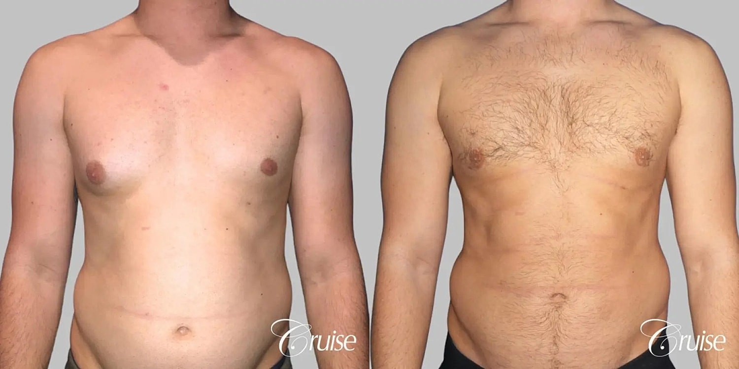 Gynecomastia Before & After
