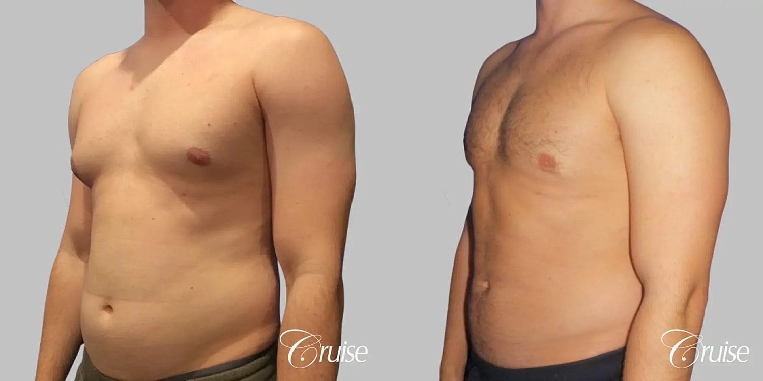 Gynecomastia Before & After
