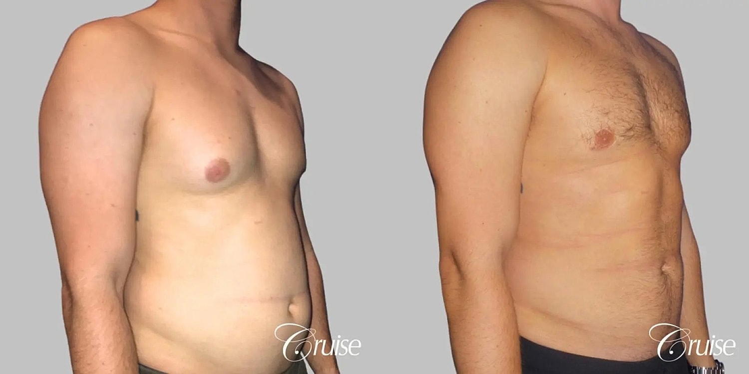 Gynecomastia Before & After
