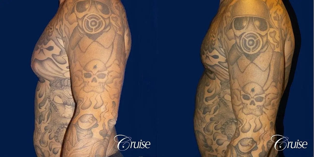 Gynecomastia Before & After