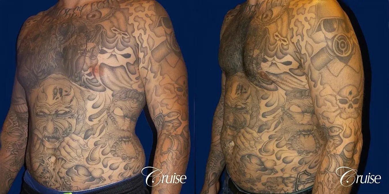 Gynecomastia Before & After