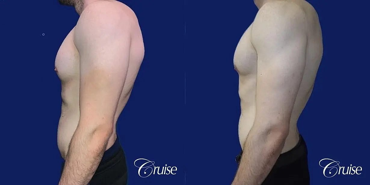 Gynecomastia Before & After