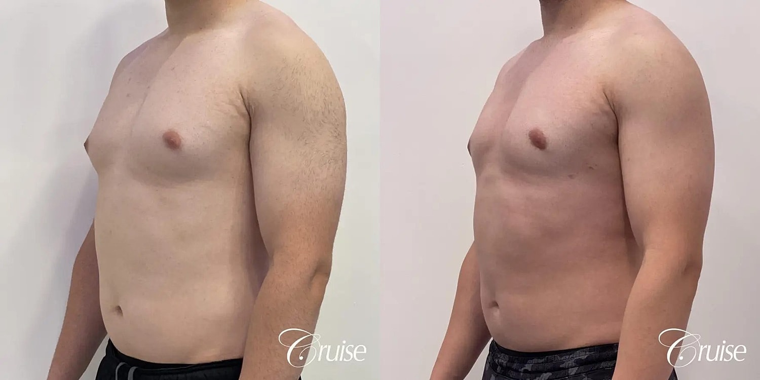Gynecomastia Before & After