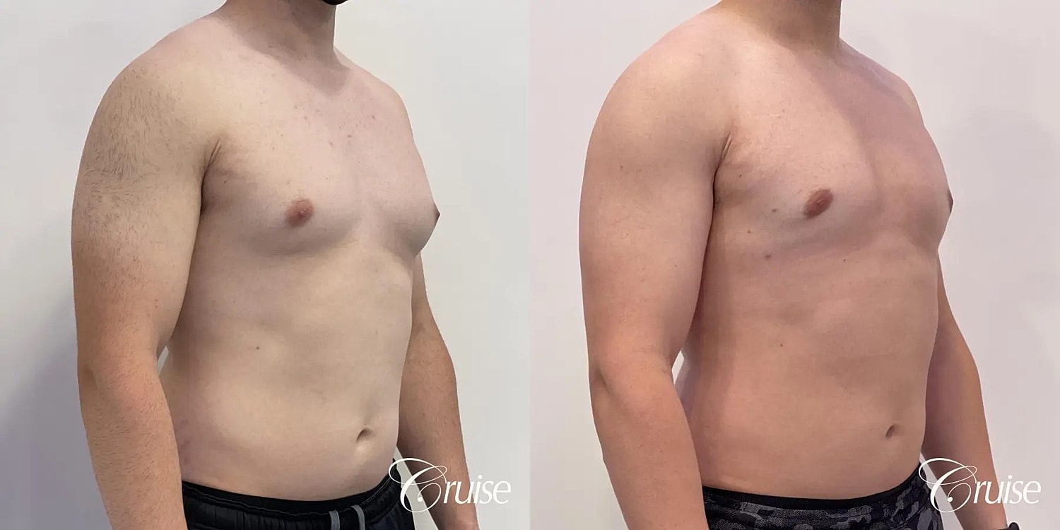 Gynecomastia Before & After