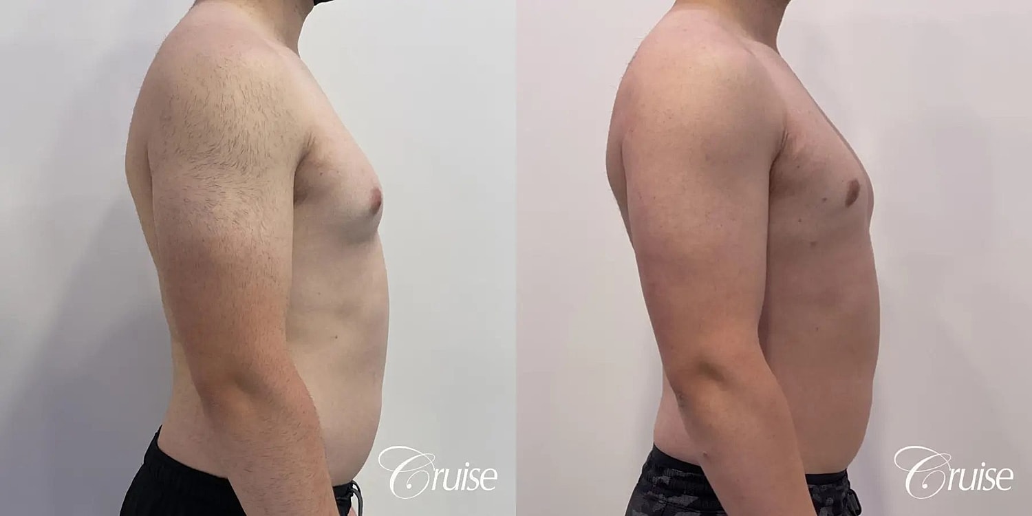 Gynecomastia Before & After